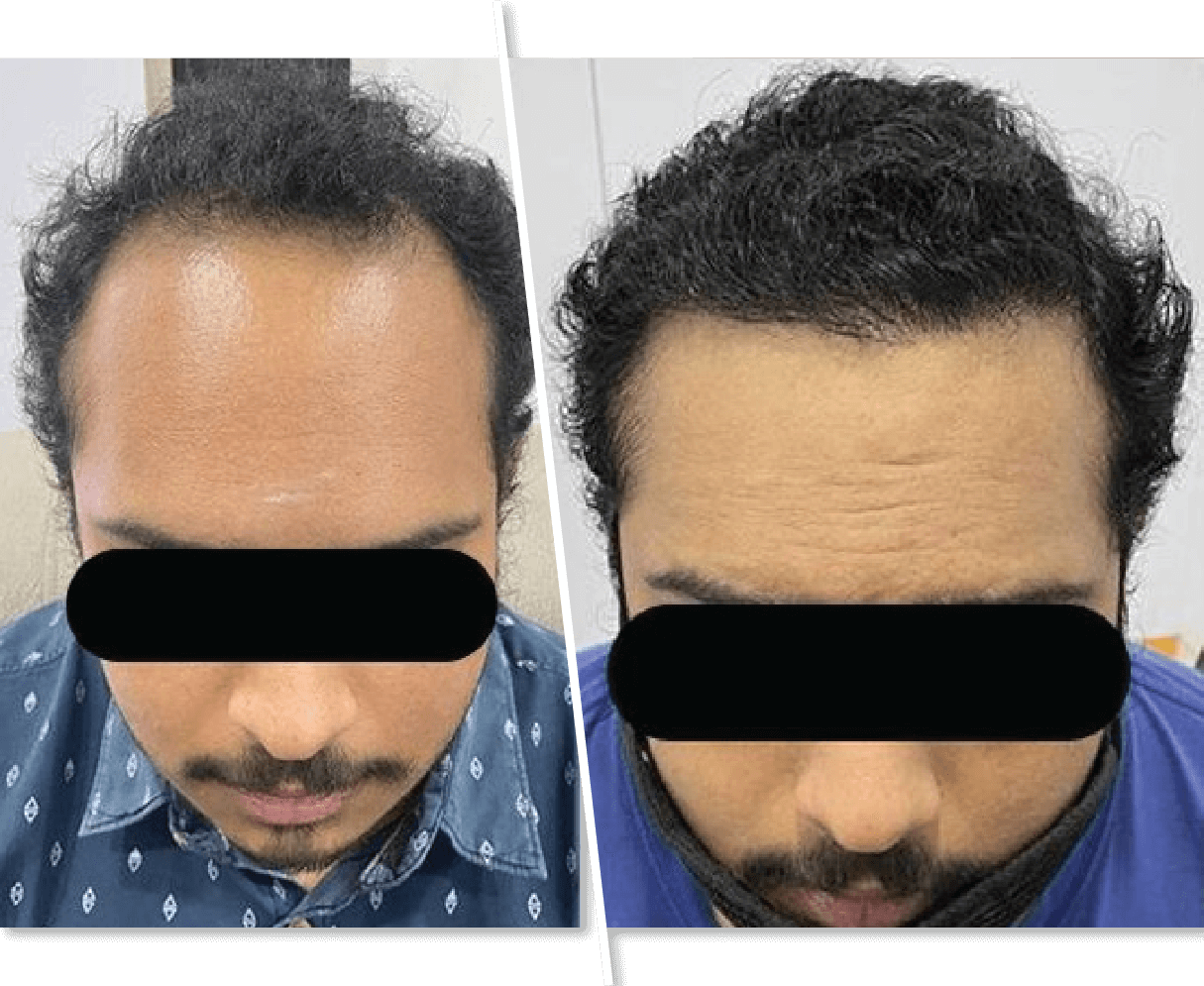 Hair Care Treatment Before and After